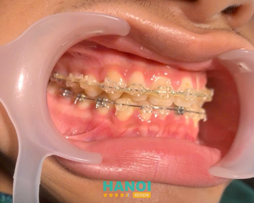 Nha Khoa Việt Mỹ Sóc Sơn