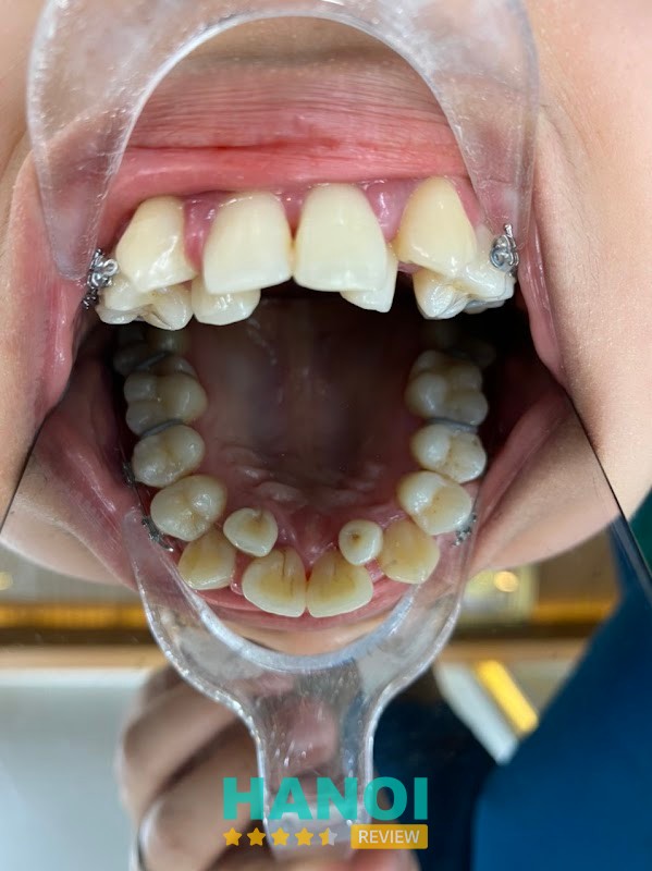 Nha khoa Thẩm mỹ Vdental (Bs Trần Trí Đạt) hình ảnh 3
